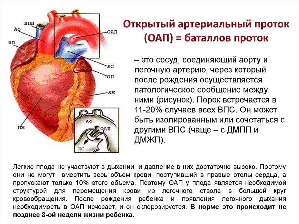 Открытый артериальный проток схема