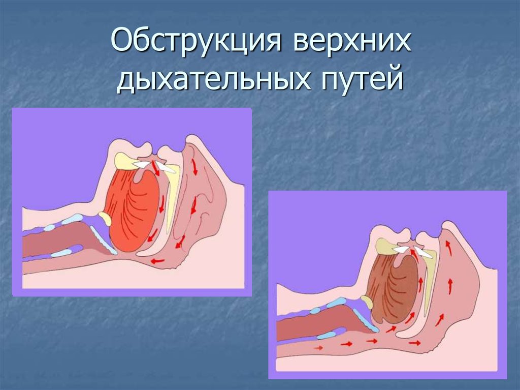 Закупорка дыхательных путей. Обструкция дыхательных путей. Обструкция верхних дыхательных путей. Обтурация дыхательных путей. Непроходимость дыхательных путей.