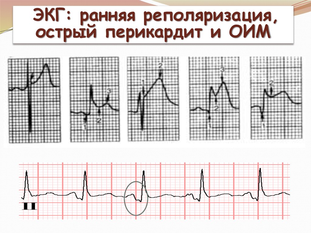 Ранняя реполяризация. Ранняя реполяризация на ЭКГ. Реполяризация это в ЭКГ. Перикардит ЭКГ картина. Ранние ЭКГ признаки острого перикардита.