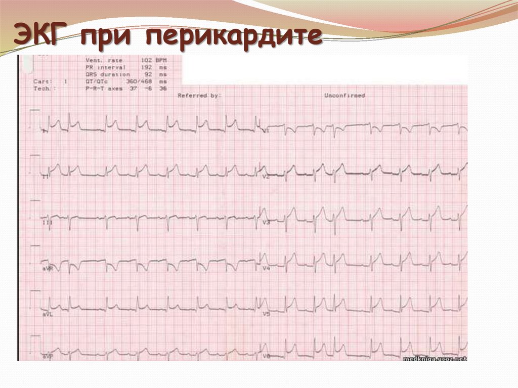 Перикардит экг картина