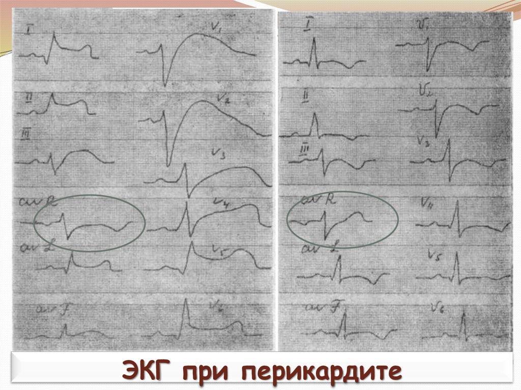 Перикардит экг картина