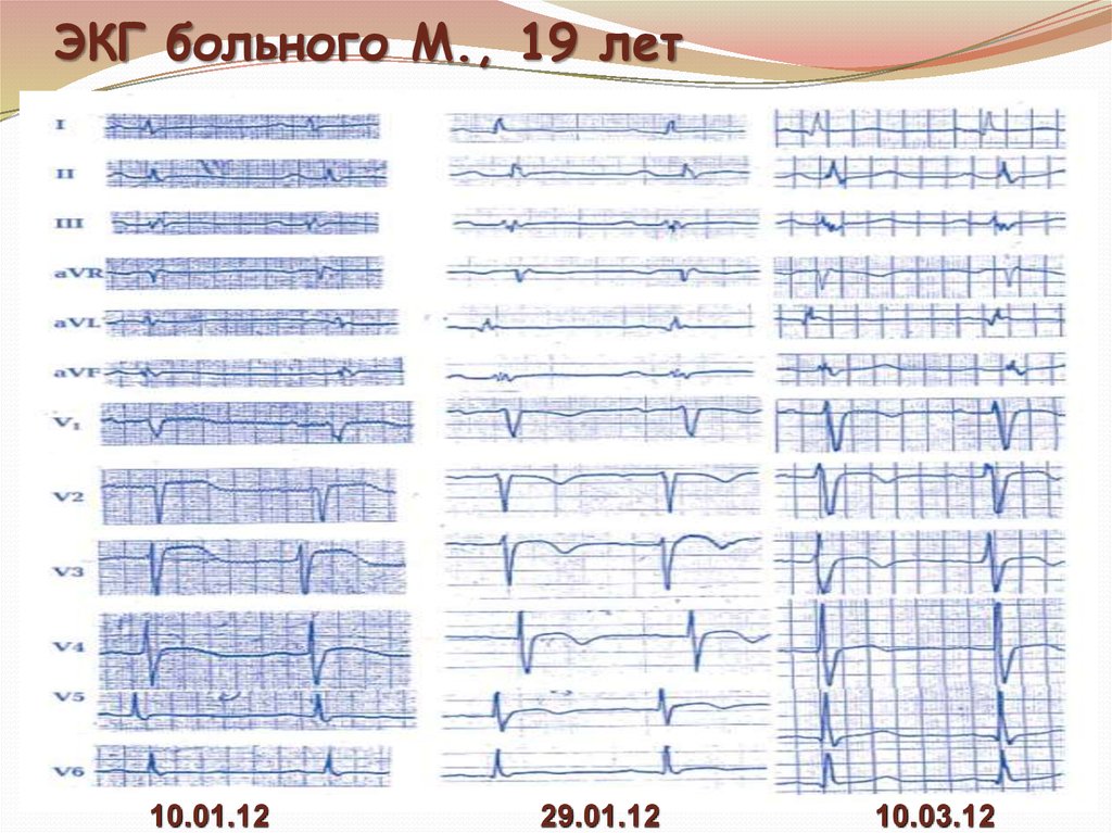 Экг пациентов. ЭКГ при перикардите. Изменения ЭКГ при перикарде. Пример ЭКГ при перикардитах. Изменения ЭКГ при перикардите носят следующий характер.