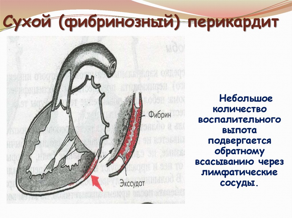 Перикардит. Сухой перикардит. Сухой и экссудативный перикардит. Перикардит сухой и выпотной. Сухой фибринозный перикардит.