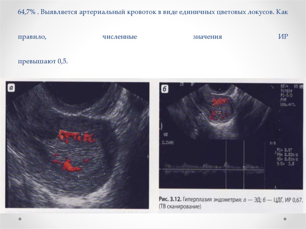 Полип эндометрия размеры. Эхограмма гиперплазии эндометрия. Полипоз эндометрия на УЗИ. Гиперпластические процессы эндометрия УЗИ.