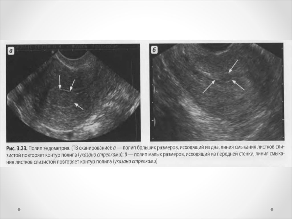 Полость матки неоднородная. Полип цервикального канала на УЗИ. Эхограмма гиперплазии эндометрия.