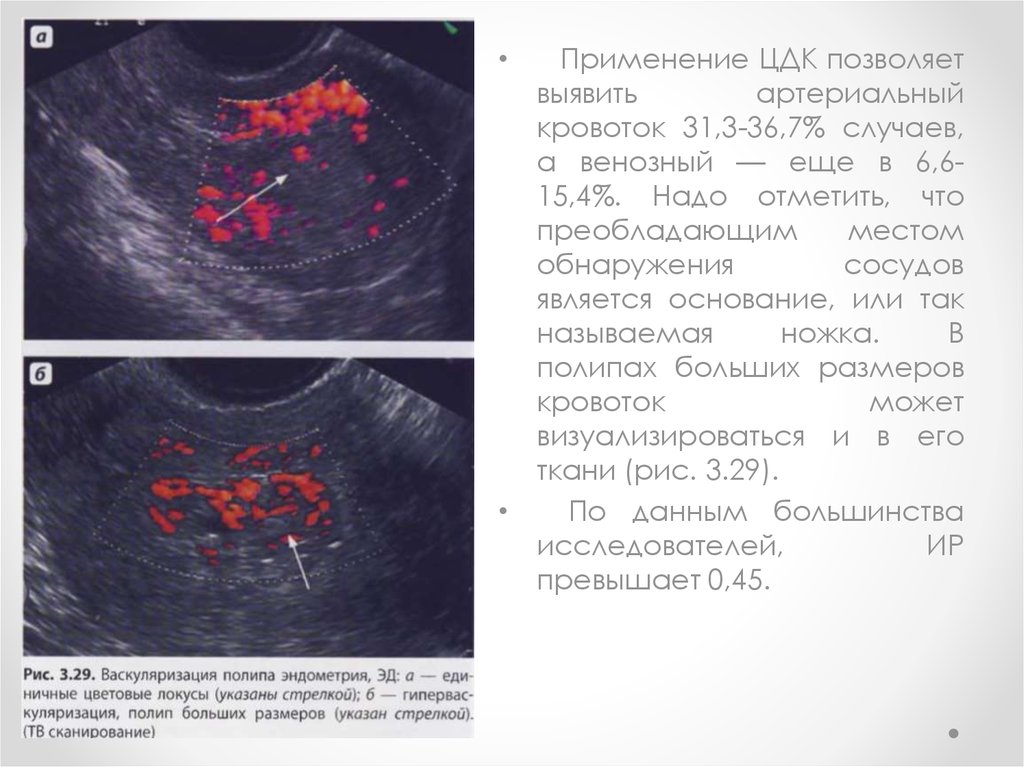 Толщина эндоцервикса. Цветовое допплеровское картирование при полипах эндометрия. Полипоз эндометрия на УЗИ. Кровоток в полип эндометрия УЗИ.