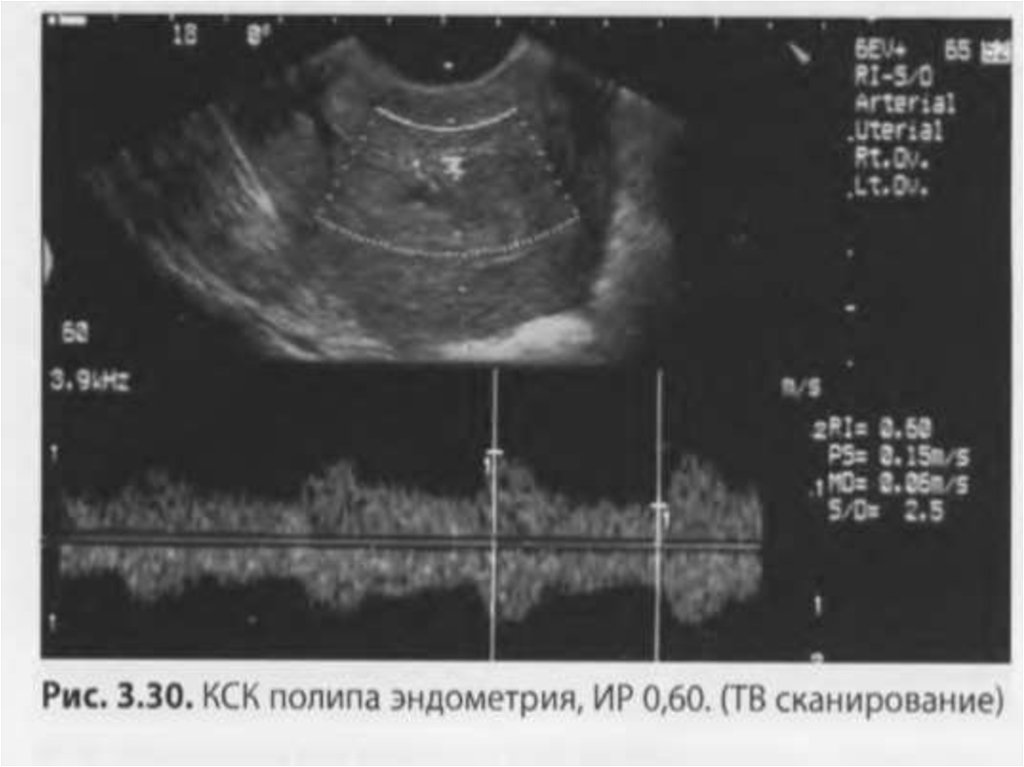 Гиперплазия эндометрия ответы