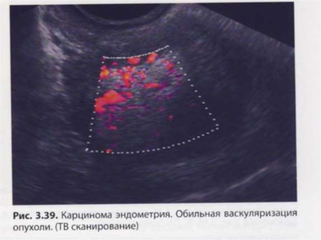 Гиперплазия эндометрия МФЯ. Очаговая гиперплазия эндометрия на УЗИ. Эхограмма гиперплазии эндометрия.