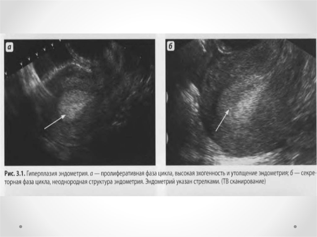 Чистка при гиперплазии эндометрия