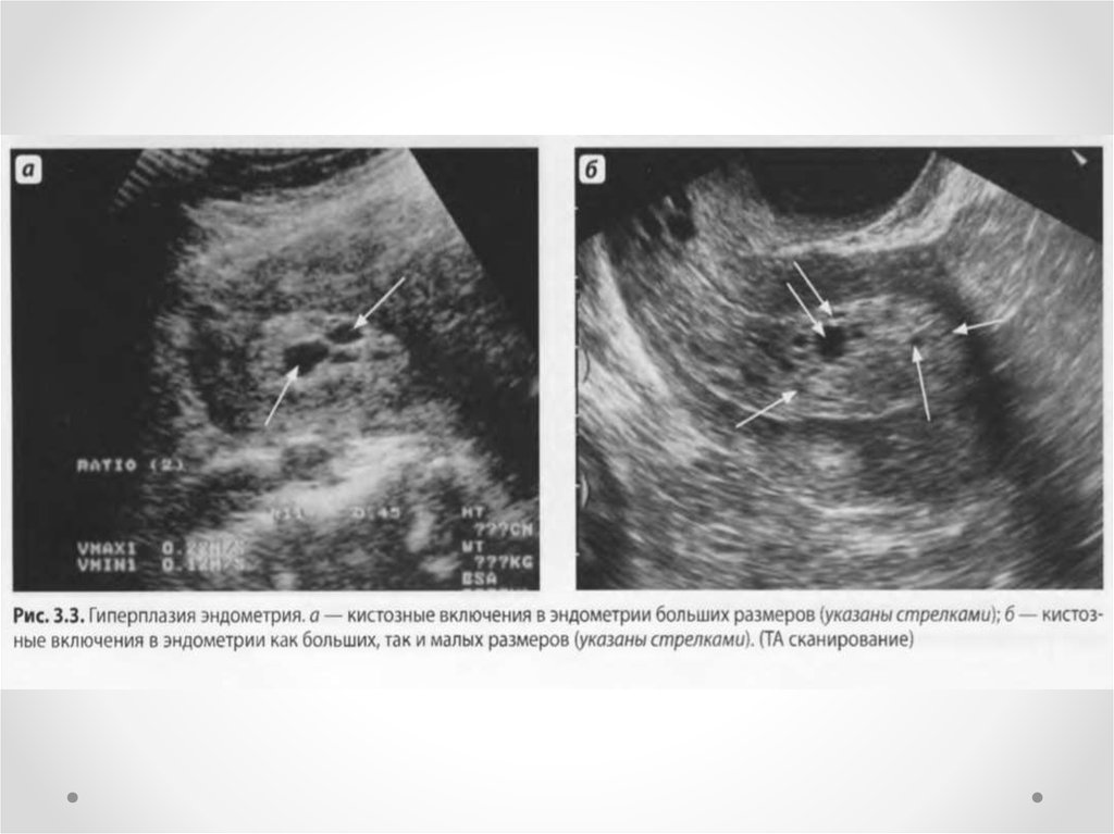 Узи эндометрия. Эхография гиперплазии эндометрия. Кистозные включения УЗИ эндометрий. Гиперпластические процессы эндометрия УЗИ. Кистозная гиперплазия эндометрия на УЗИ.
