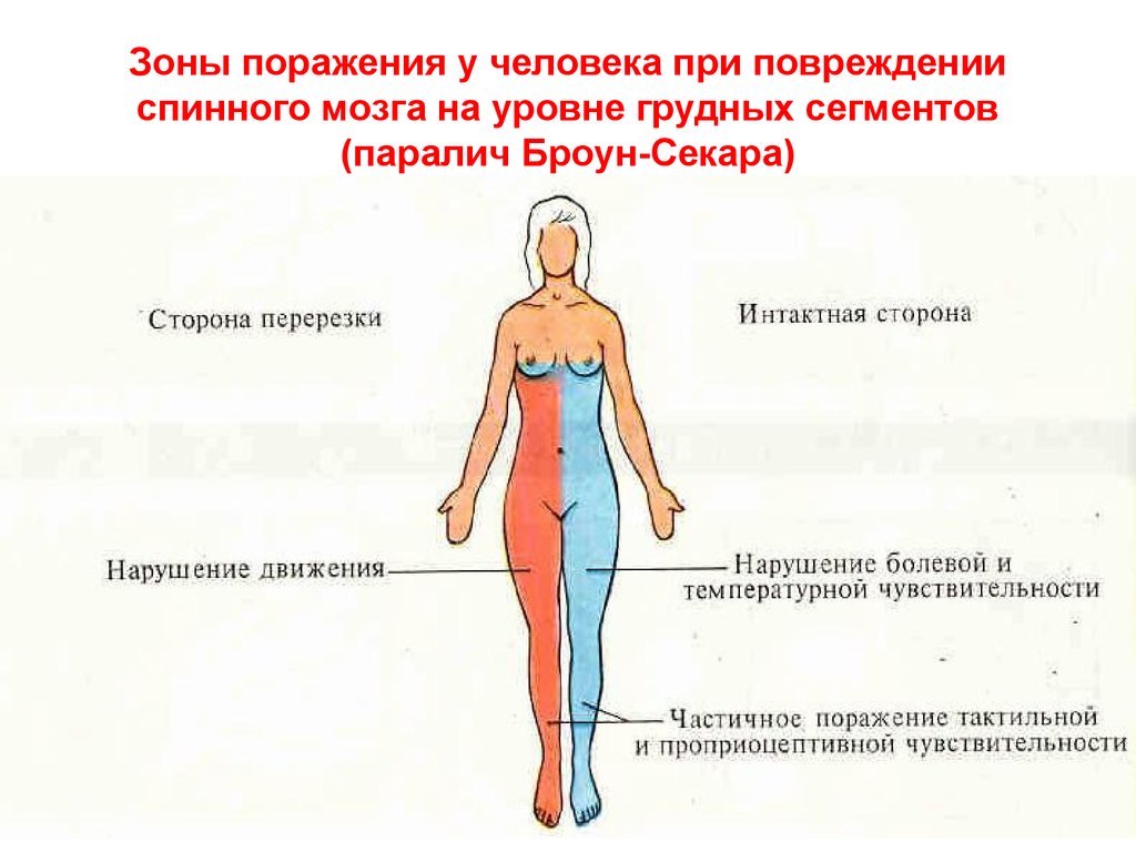 Нарушение ч. Спинной мозг синдром Броун-Секара. Синдром Броун Секара физиология. Броун Секаровский синдром неврология.