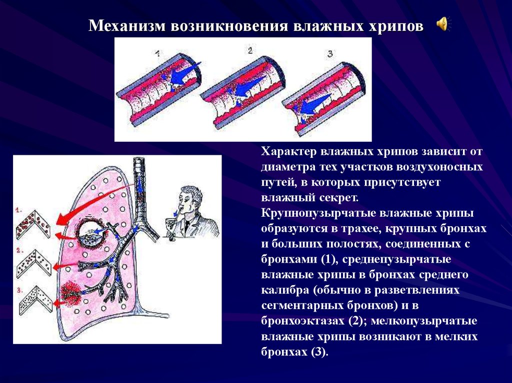 Механизм возникновения. Механизм образования мелкопузырчатых хрипов. Механизм возникновения влажных хрипов. Механизм образования сухих и влажных хрипов. Механизм образования мелкопузырчатых хрипов влажных.