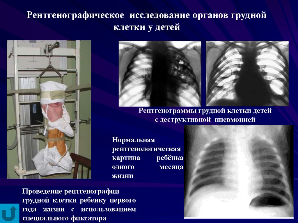Делают рентген грудной клетки ребенку. Рентген исследование грудной клетки. Рентген грудной клетки ребенку. Рентгенография органов грудной клетки у детей. Проведение рентгенографии органов грудной клетки.