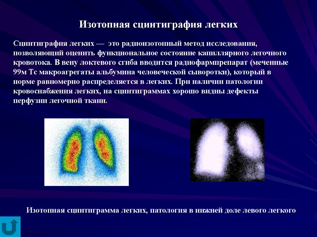 Исследования позволяют увидеть. Радиоизотопные методы исследования суставов. Радиоизотопная сцинтиграфия. Сцинтиграфия метод исследования. Ингаляционная сцинтиграфия легких.