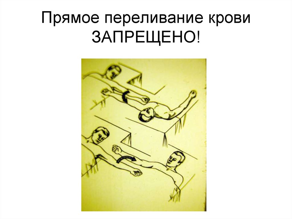 Прямое переливание крови ЗАПРЕЩЕНО!
