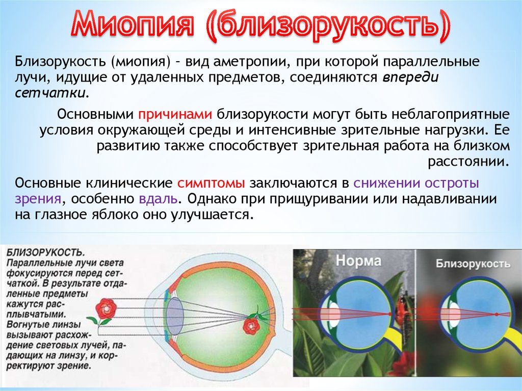 Миопия при беременности презентация