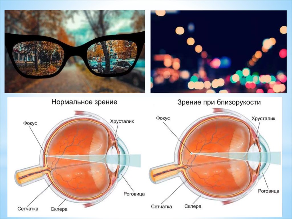 1 это нормальное зрение. Острота зрения. Рефракция. Аккомодация.. Астигматизм и нормальное зрение. Нормальное зрение и близорукость. Аномалии рефракции глаза.