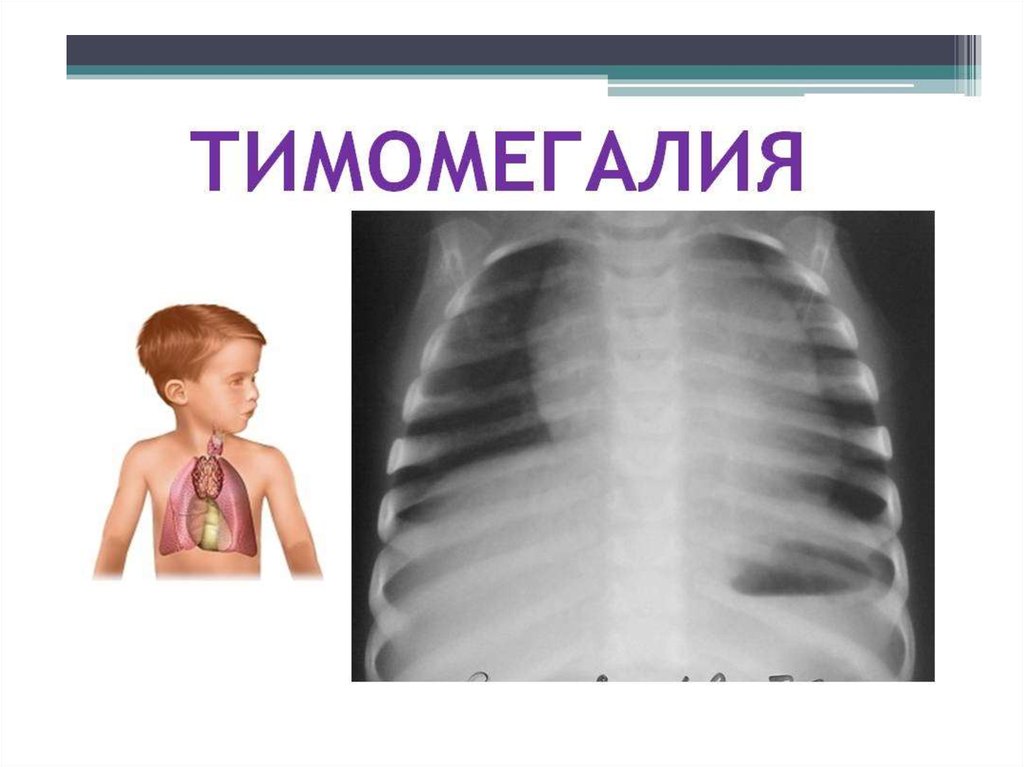 Дети 2 степени. Тимомегалия 2 степени у грудничка. Тимомегалия 1-2 степени у грудничка. Тимомегалия у детей рентгенодиагностика.