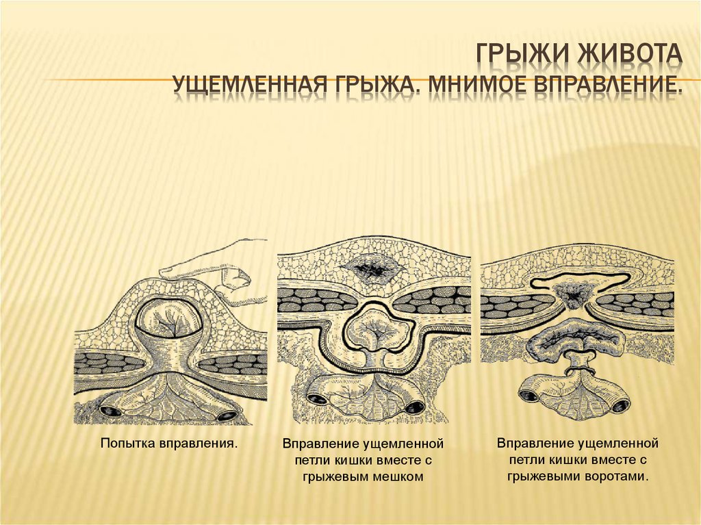 Вправление ущемленной грыжи. Мнимое вправление грыж живота. Ложное ущемление грыжа Брока. Мнимое вправление ущемленной грыжи. Грыжи живота ущемленные грыжи.