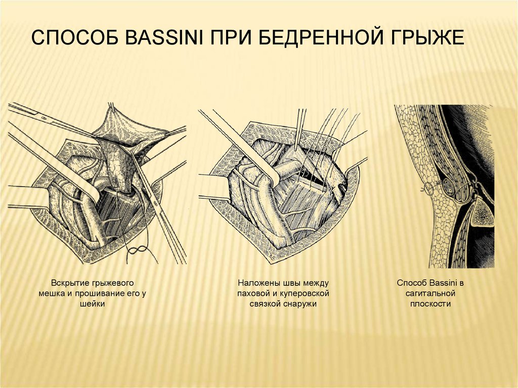 Бедренный способ при бедренной грыже. Бедренная грыжа способ Бассини. Пластика Бассини при бедренных грыжах. Операция по Бассини при бедренной грыже. Способ Бассини при паховой грыже.