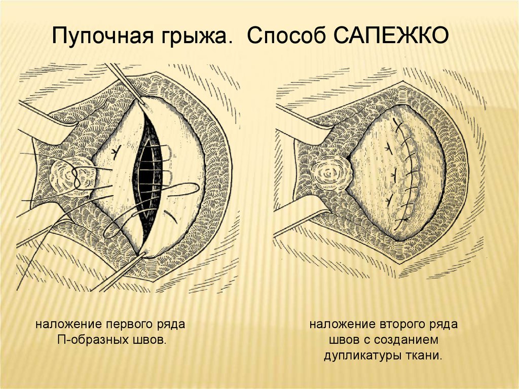 Пластика пупочной грыжи. Герниопластика по Сапежко схема. Пластика по Сапежко при пупочной грыже. Пупочная грыжа по Сапежко.