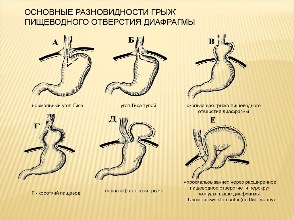 Какая грыжа на пищеводе