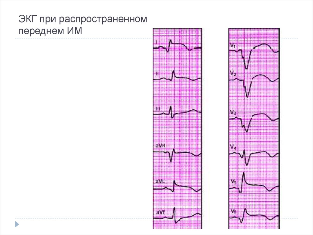 ЭКГ при пневмонии. Изменения на ЭКГ при пневмонии. ЭКГ при воспалении. ЭКГ при переохлаждении.