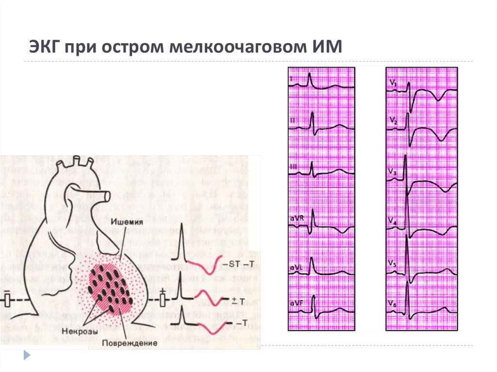 Экг при инфаркте. ЭКГ при инфаркте миокарда ишемическом повреждении ишемии. ЭКГ при ишемической болезни. Трансмуральная ишемия передней стенки ЭКГ. Мелкоочаговый инфаркт миокарда на ЭКГ.