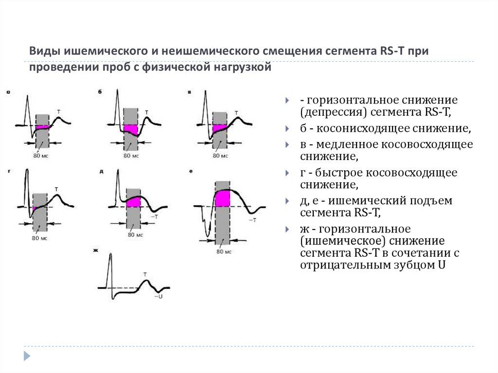 Метаболические изменения на экг