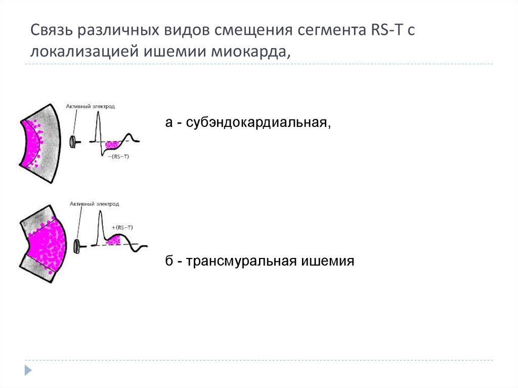 Тип смещения. Трансмуральная ишемия на ЭКГ. Трансмуральная и субэндокардиальная ишемия. Сегмент и смещение. Смещение сегментного ишемического характера.