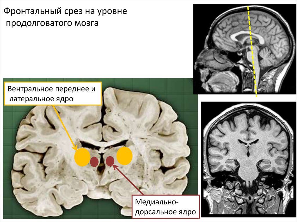 Фронтальный срез. Срез продолговатого мозга. Фронтальный срез продолговатого мозга. Срез на уровне продолговатого мозга.