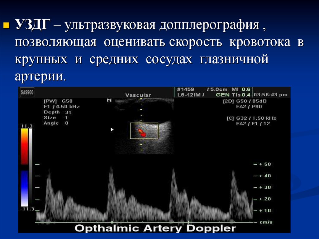 Допплерография. Ультразвуковая допплерография глаза. УЗДГ допплерография печени. Ультразвуковая высокочастотная допплерография. Допплерография в импульсном режиме парных сосудов.