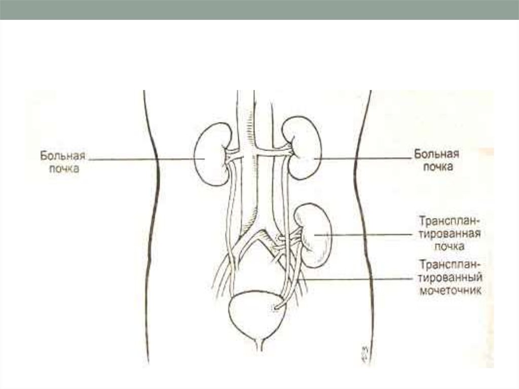 Трансплантация почки схема