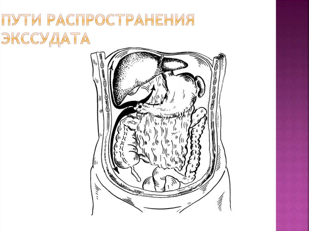 Наличие гноя в брюшной полости. Распространенный Гнойный перитонит. Воспалительный экссудат в брюшной полости. Перитонит брюшной полости.