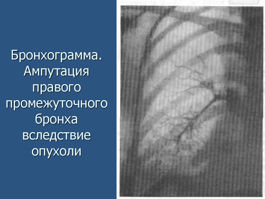 Бронхограмма. Ампутация правого промежуточного бронха вследствие опухоли