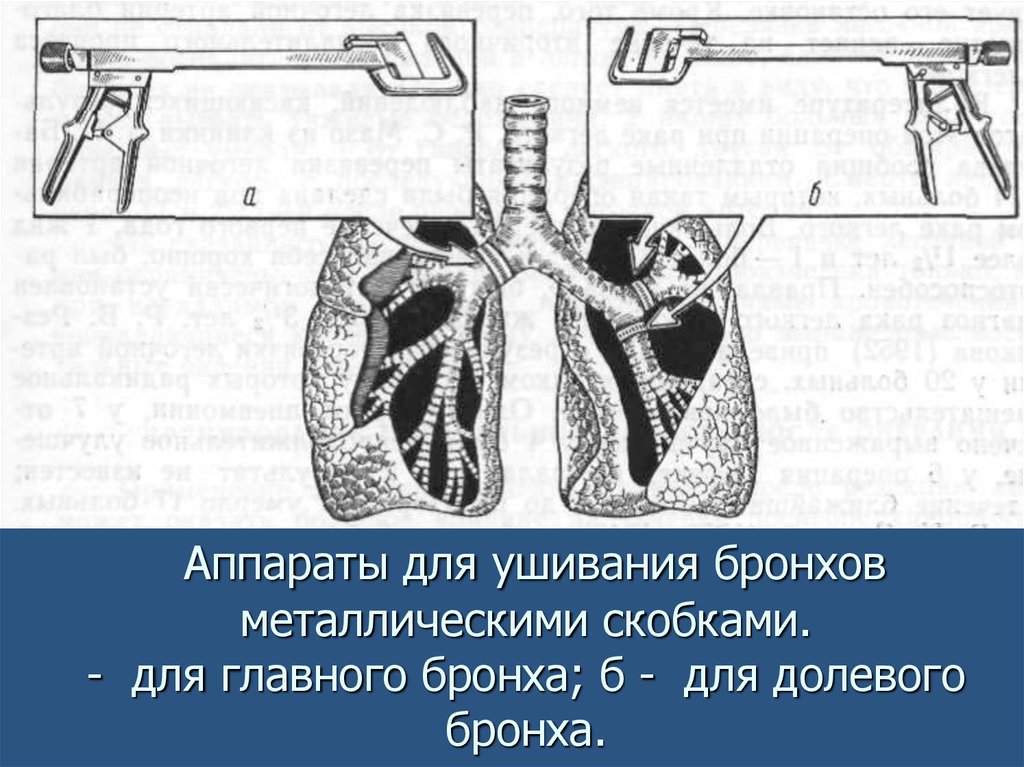 Аппараты для ушивания бронхов металлическими скобками. - для главного бронха; б - для долевого бронха.