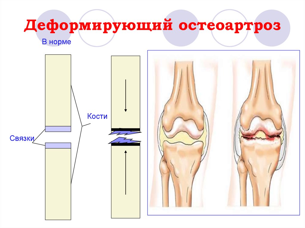 Деформирующий остеоартроз. Остеоартроз буклеты. Деформирующий остеоартроз причины. Деформирующий остеоартроз рекомендации.