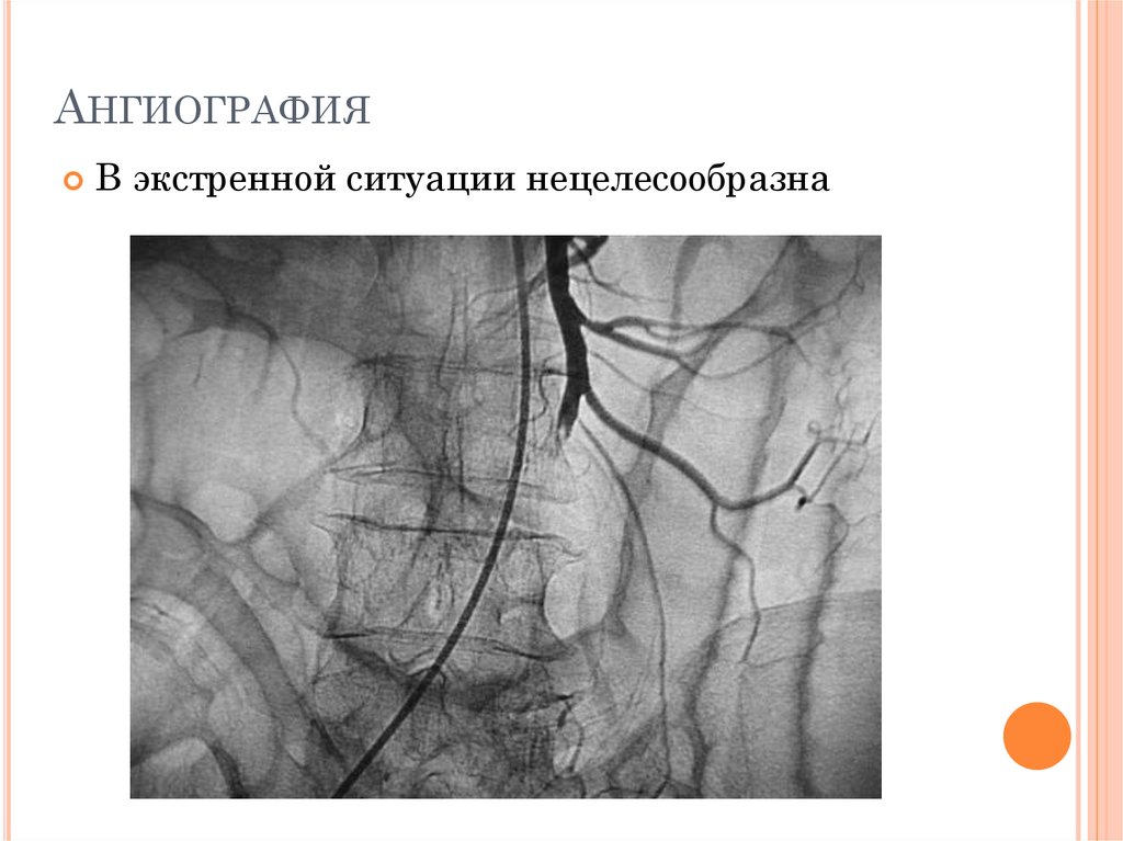 Острый мезентериальный тромбоз. Тромбоз мезентериальных артерий. Тромбоз верхней брыжеечной артерии. Тромбоз мезентериальных вен. Мезентериальный тромбоз верхней брыжеечной артерии..