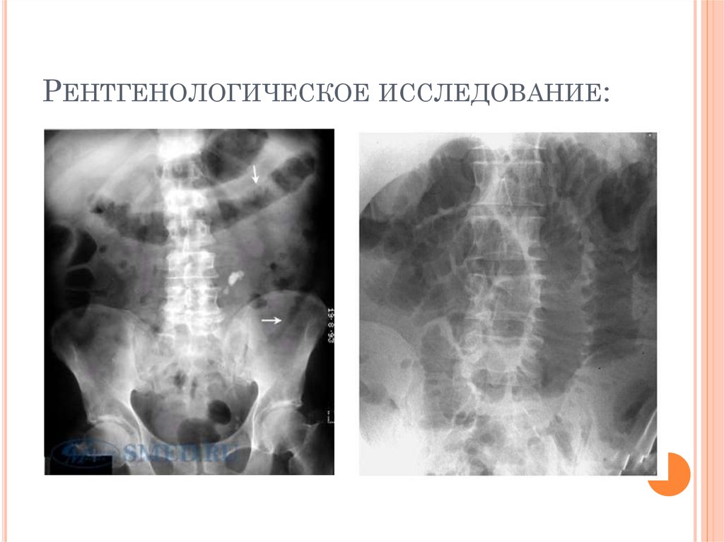 Мезентериальный тромбоз презентация