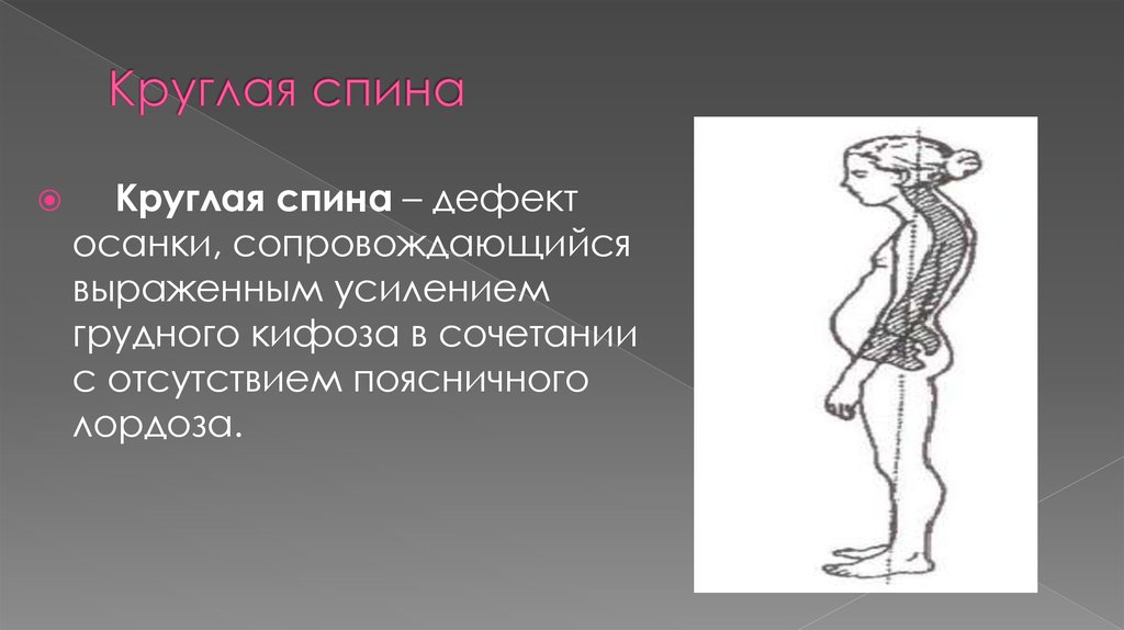 Круглая спина