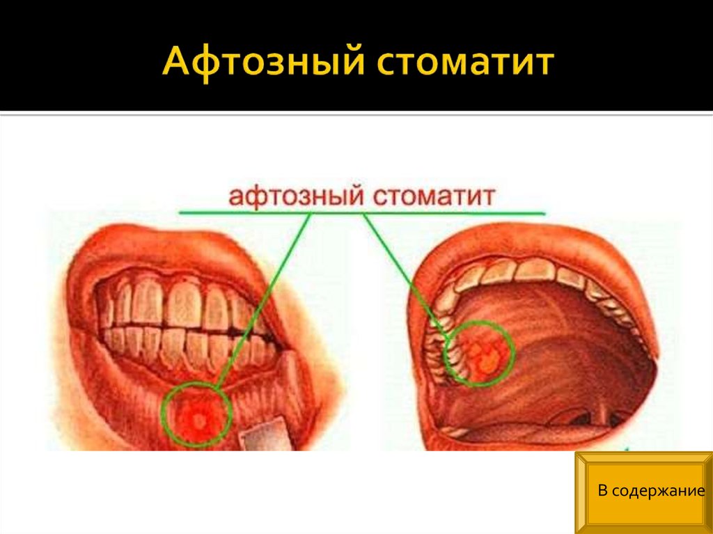 Язвенный стоматит картинки