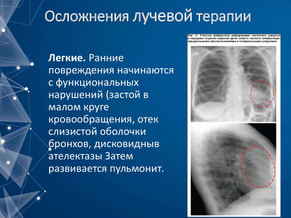 Показания и противопоказания к проведению лучевой терапии презентация