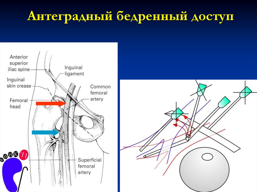 Укол в паховую вену схема описание