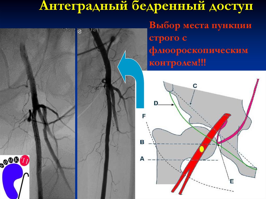 Бедренная пункция. Пункция бедренной артерии. Антеградная пункция бедренной артерии. Пункция бедренной артерии по Сельдингеру. Прокол бедренной артерии.