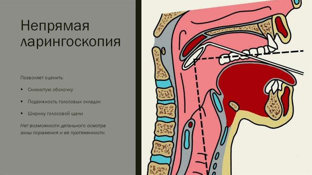 Фарингоскопия. Ларингоскопия надгортанника. Прямая ларингоскопия гортани. Надгортанник непрямая ларингоскопия. Гипофарингоскопия (непрямая ларингоскопия)..