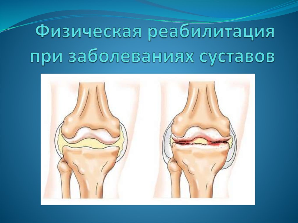 Болезни суставов презентация