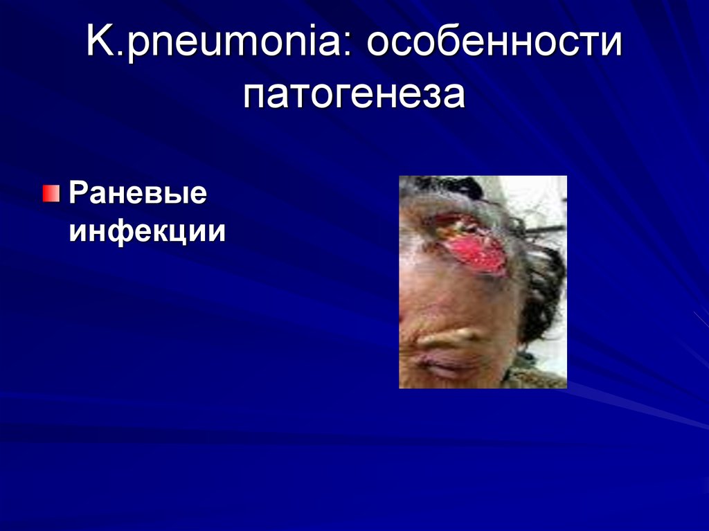 K.pneumonia: особенности патогенеза