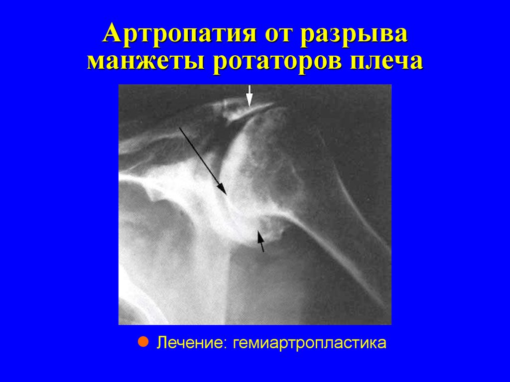 Разрыв ротаторной. Разрыв ротаторной манжеты плечевого сустава рентген. Разрыв сухожилия надостной мышцы плечевого сустава рентген. Повреждение вращательной манжеты плечевого сустава на рентгене. Разрыв ротаторной манжеты плечевого сустава мрт.