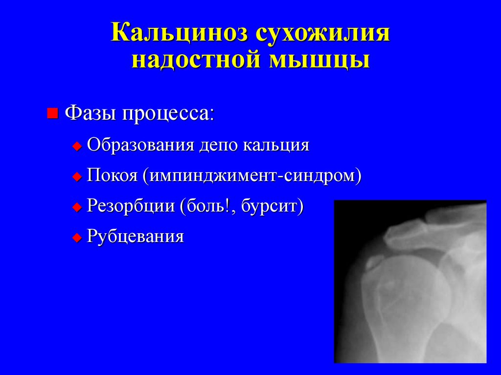 Обызвествление это. Обызвествления в плечевом суставе. Обызвествление сухожилия. Кальциноз сухожилия надостной мышцы. Обызвествление сухожилия подостной мышцы.