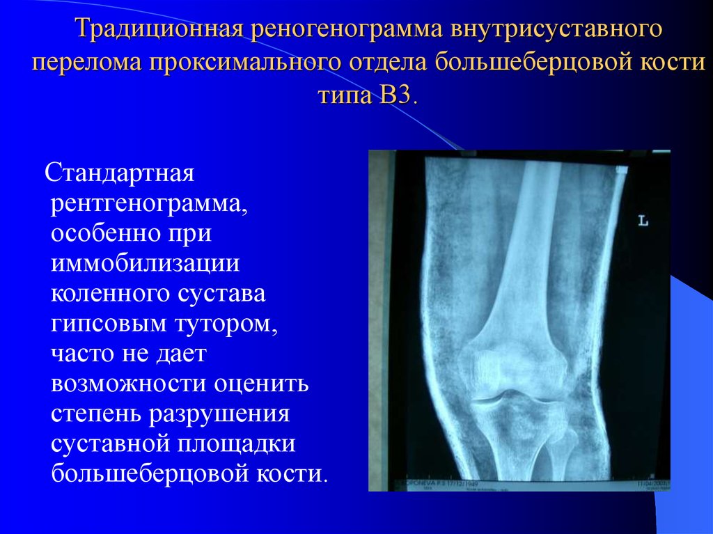 Закрытый перелом нижней трети голени карта вызова